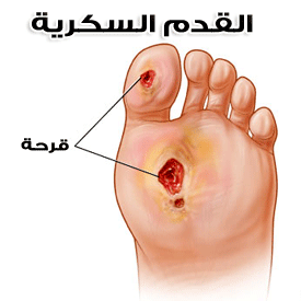 القدم السكرى