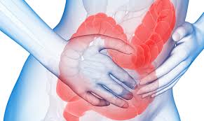 irritable bowel syndrome.