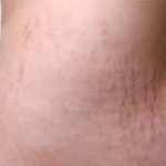 Stretch Marks